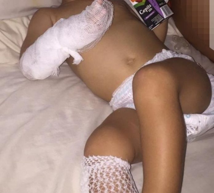 niño quemado carlos paz