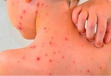 El ministerio de Salud emitió un alerta epidemiológica por nuevos casos de sarampión