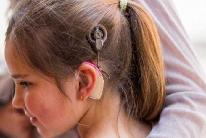 implante coclear ilustrativa